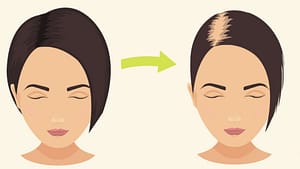 lady losing hair