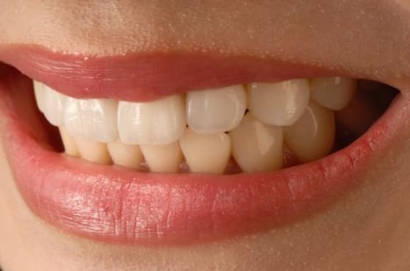 white teeth