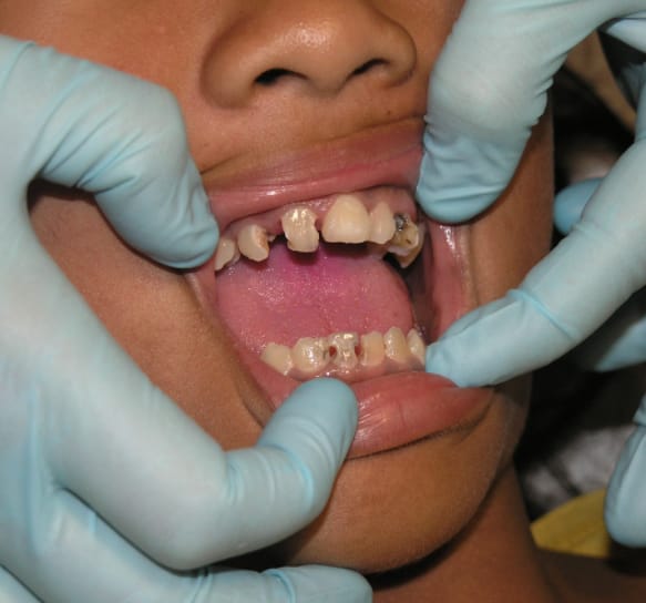 crooked teeth